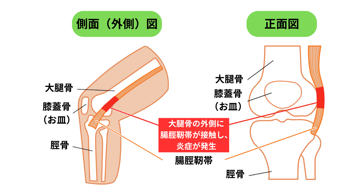 腸脛靭帯炎の図解